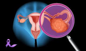 Best Gynae Cancer in Panipat