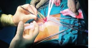 best hernia removal surgery in Panipat